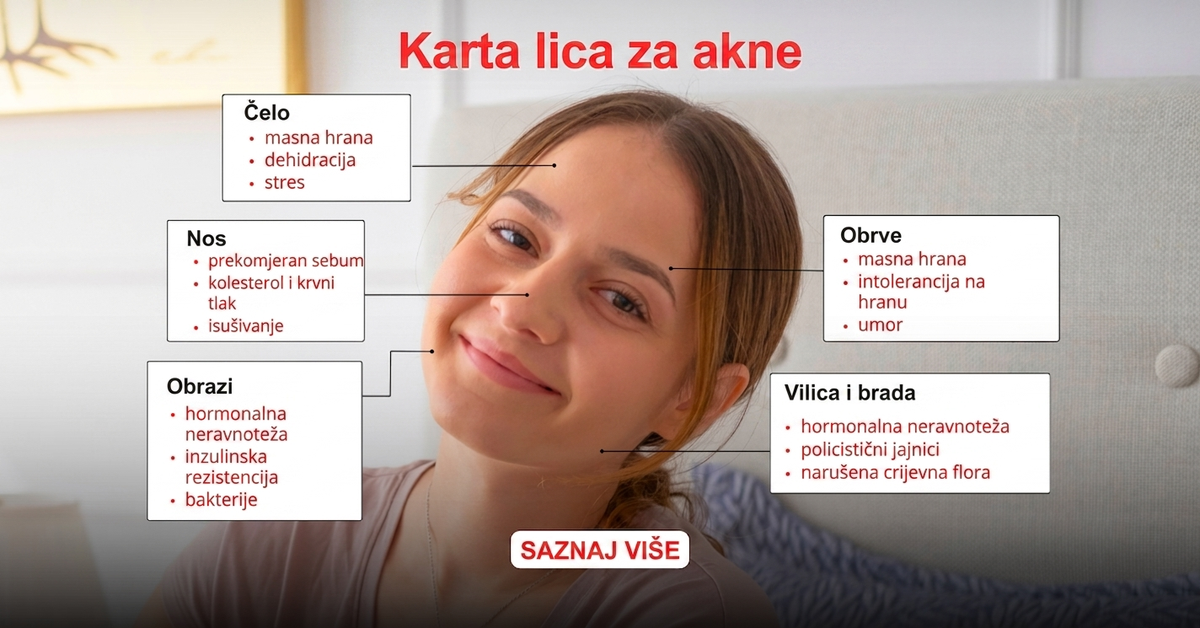 Mapa lica kod akni po zonama