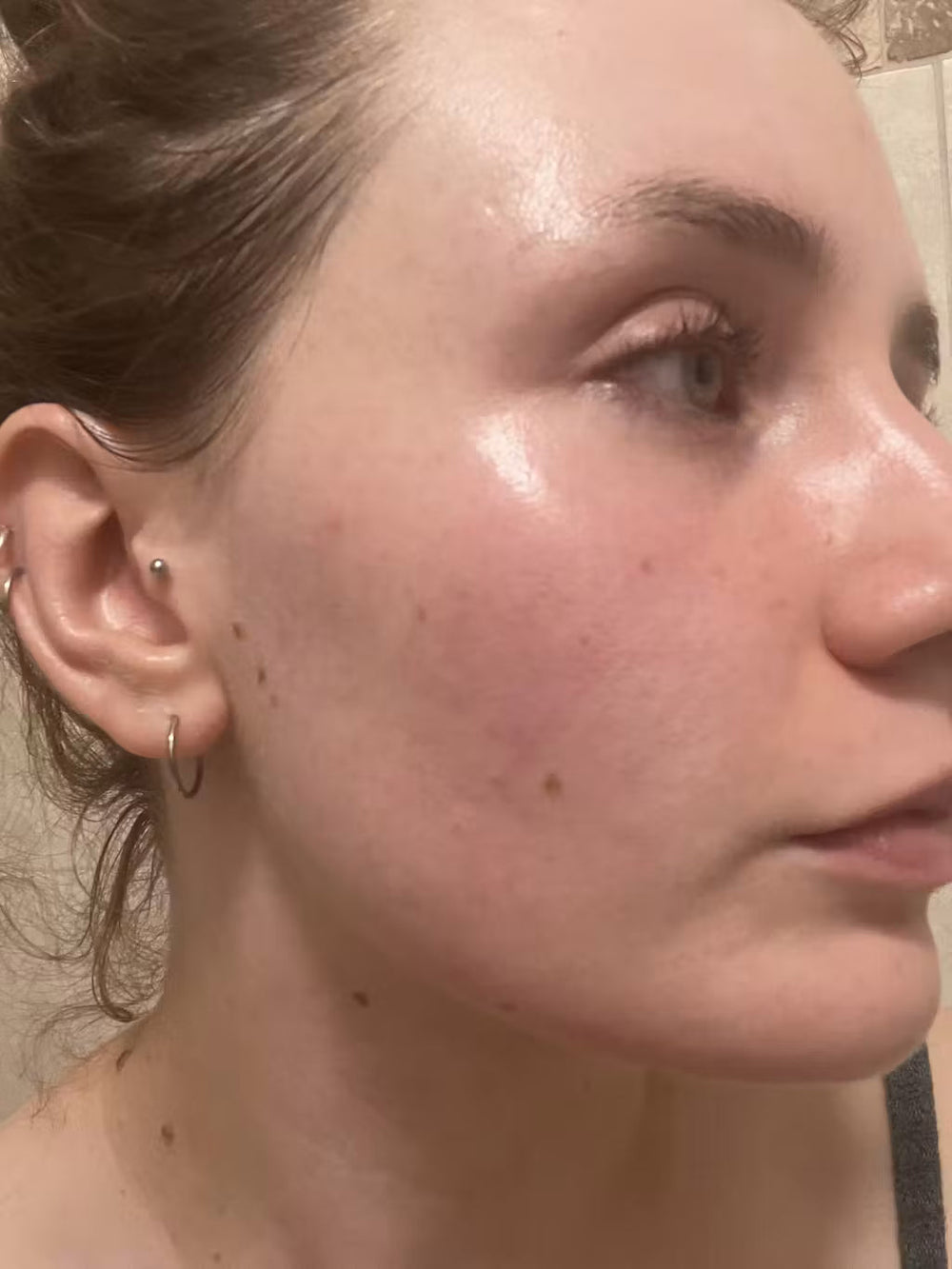 acne HR keep