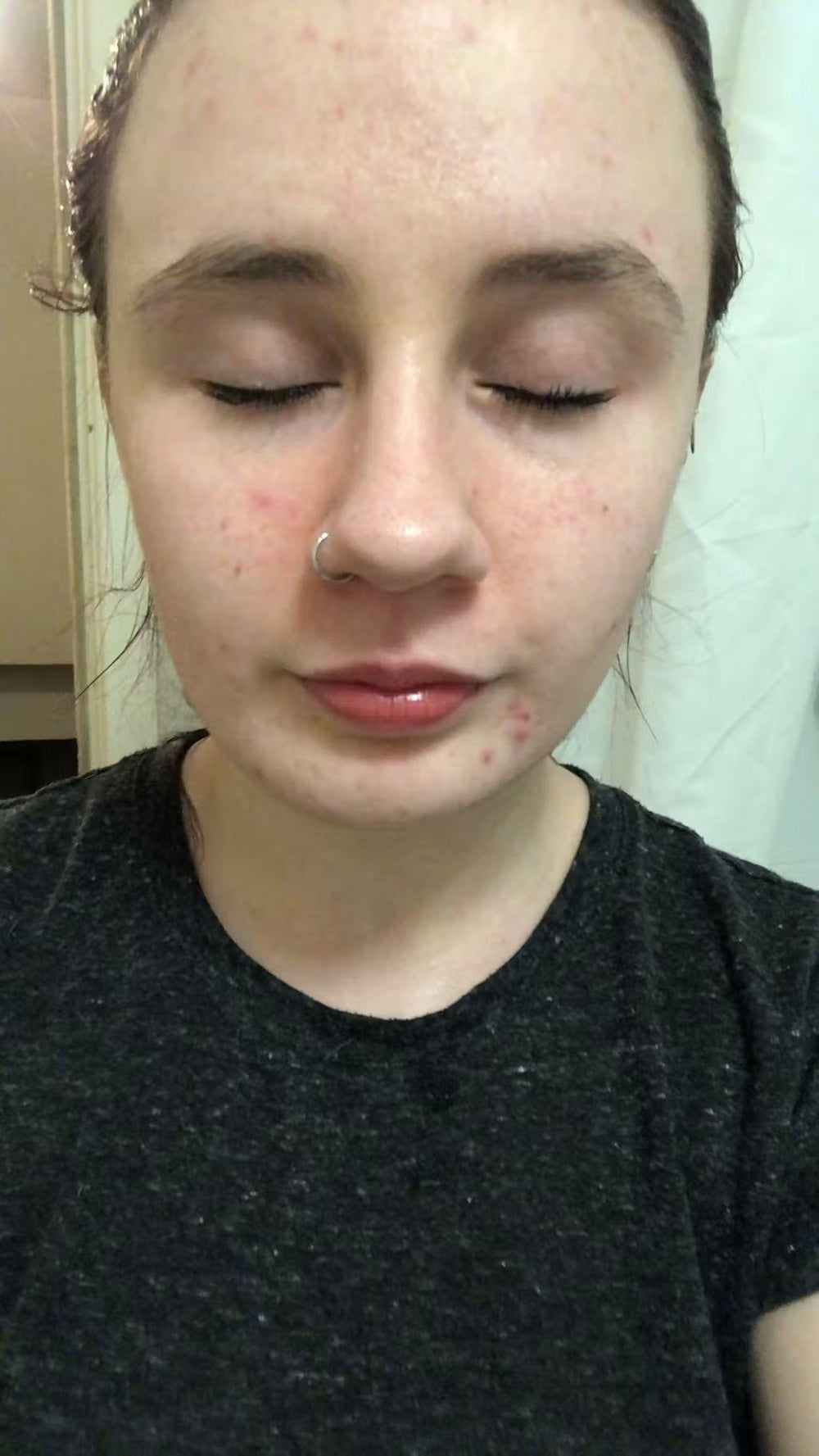 acne HR keep