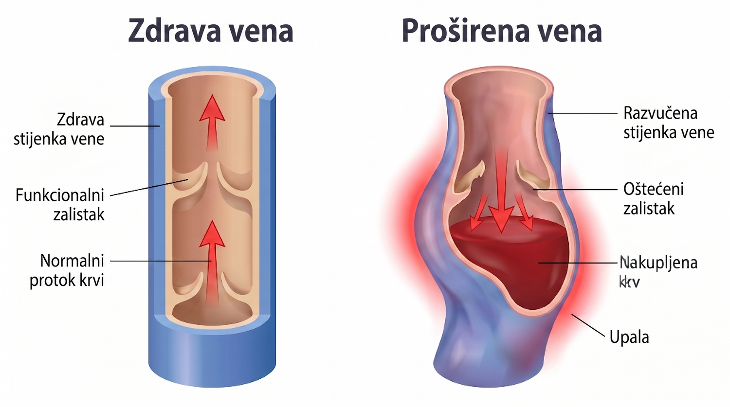 periodontis
